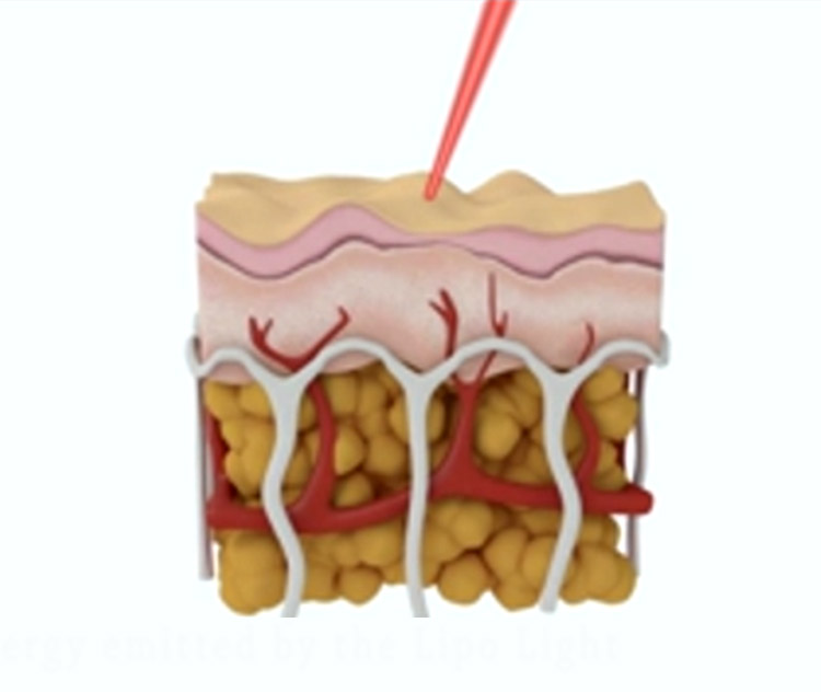Laser-Like Lipo